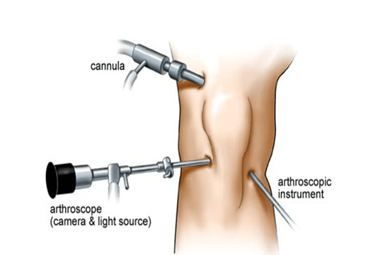 Arthroscopic Surgeries